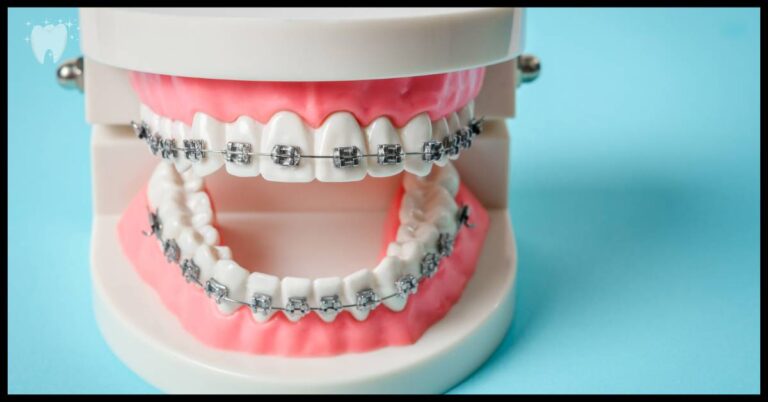 10 Reasons Why To Pick Teal Color Braces in 2023