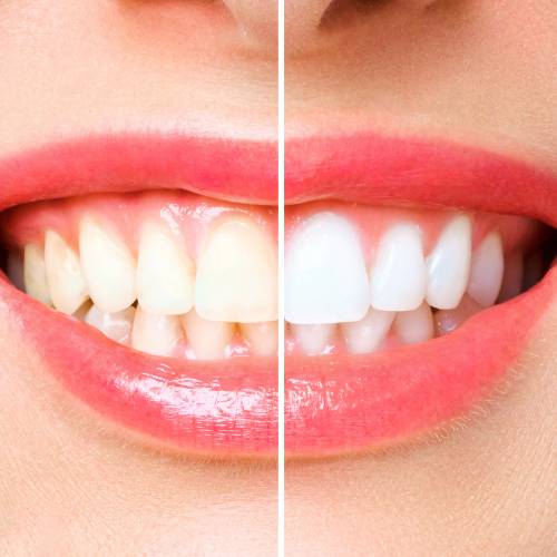 Your Journey to Dental Wellbeing Begins at ACDCDental.org 29 teeth whitening